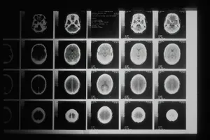 Varias imágenes en blanco y negro de un escáner cerebral, dispuestas en cuadrícula