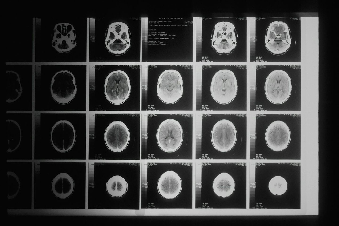 Varias imágenes en blanco y negro de un escáner cerebral, dispuestas en cuadrícula